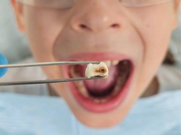 Best Emergency Wisdom Tooth Extraction in , TX